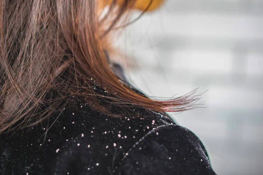 Dealing With The Dreaded D-Word: Dandruff