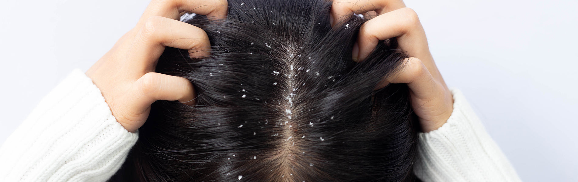 How to use Ginger for Hair to treat Dandruff in winter