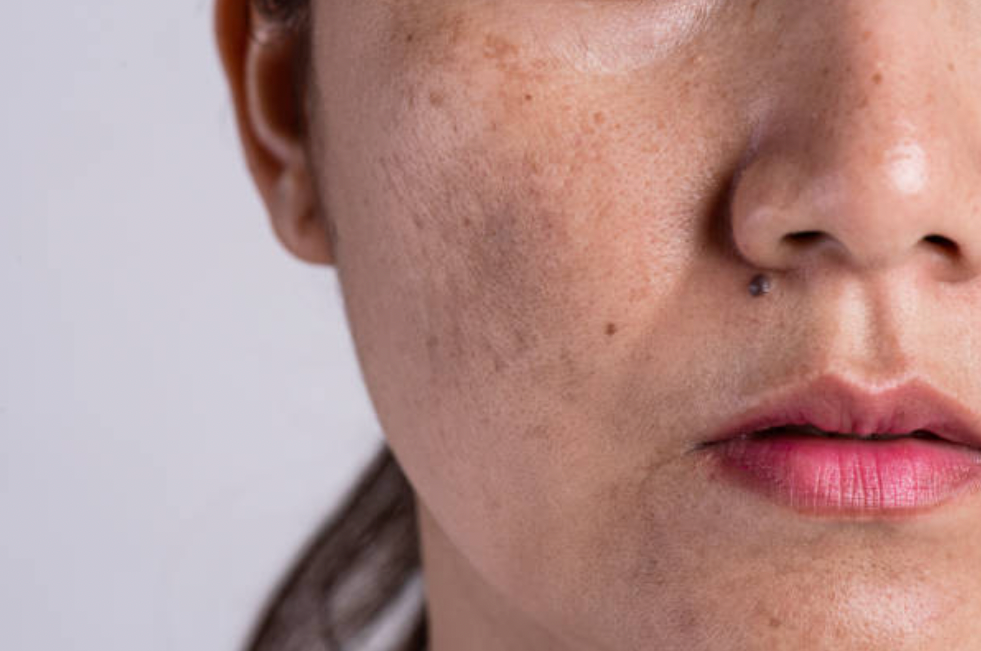 7 Home Remedies for reducing Pigmentation: How to Get Rid of Dark Spots
