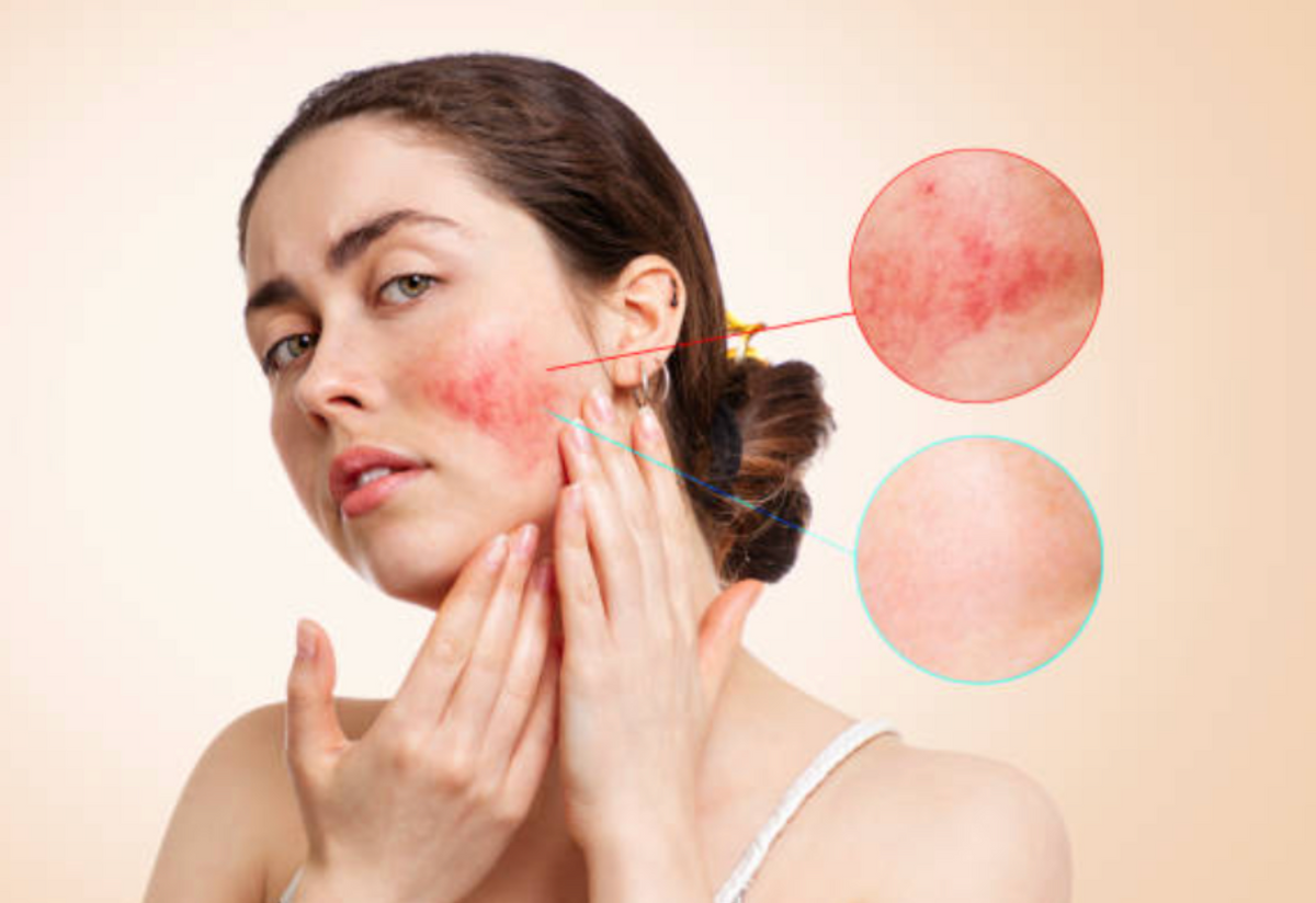 Get Rid of Face Redness: Your Ultimate Guide To 5 Causes and Effective ...