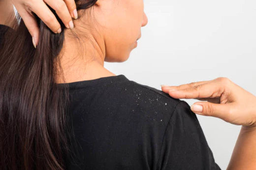 6 Incredible Home Remedies for Dandruff