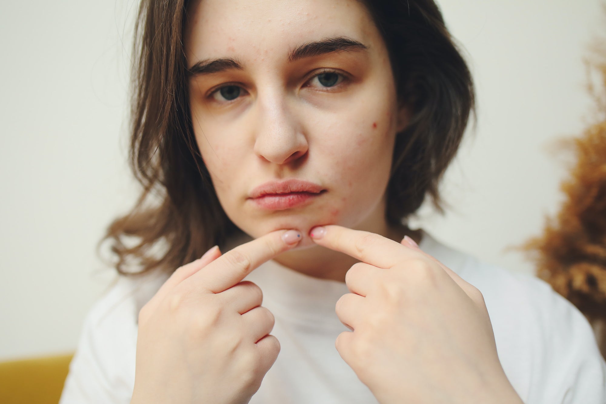 Achieving a Clear Complexion: Tips for Acne-Prone Skin