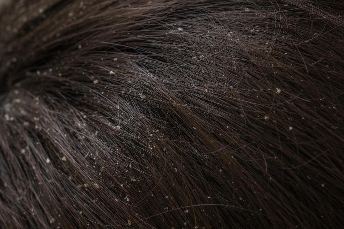 Preventing Scalp Issues During Monsoons: A Complete Guide